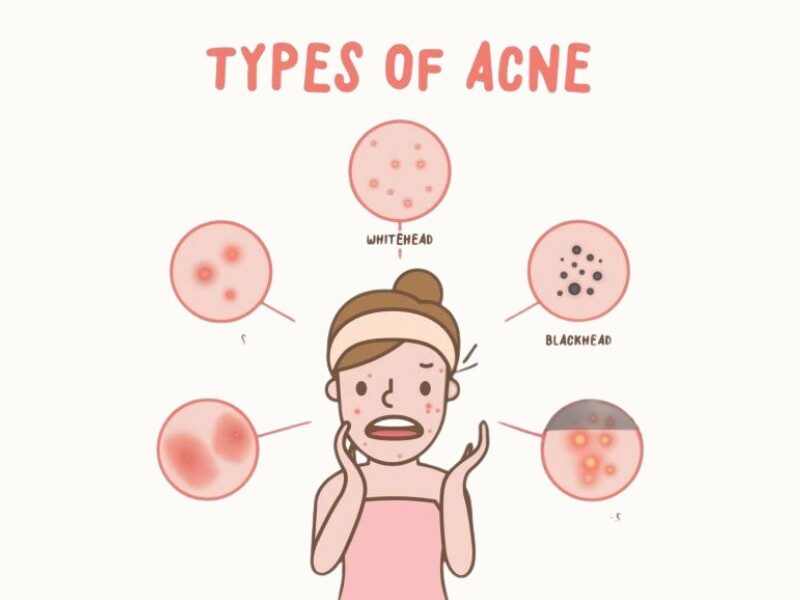 Acne Treatment Guide: Causes, Diet and Natural Remedies for Clear skin. 1 1 20250501 184155 0000