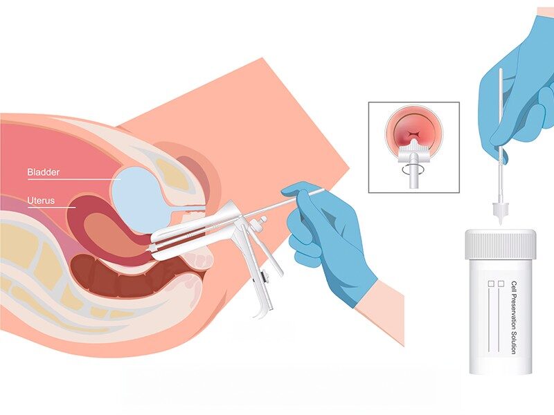 Essential Health Screenings for Women 1 Scientific diagram of Pap smear test or illustration