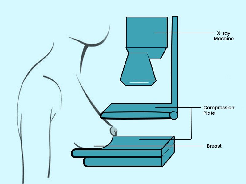 Essential Health Screenings for Women 2 Scientific diagram of mammography or illustration of breast cancer