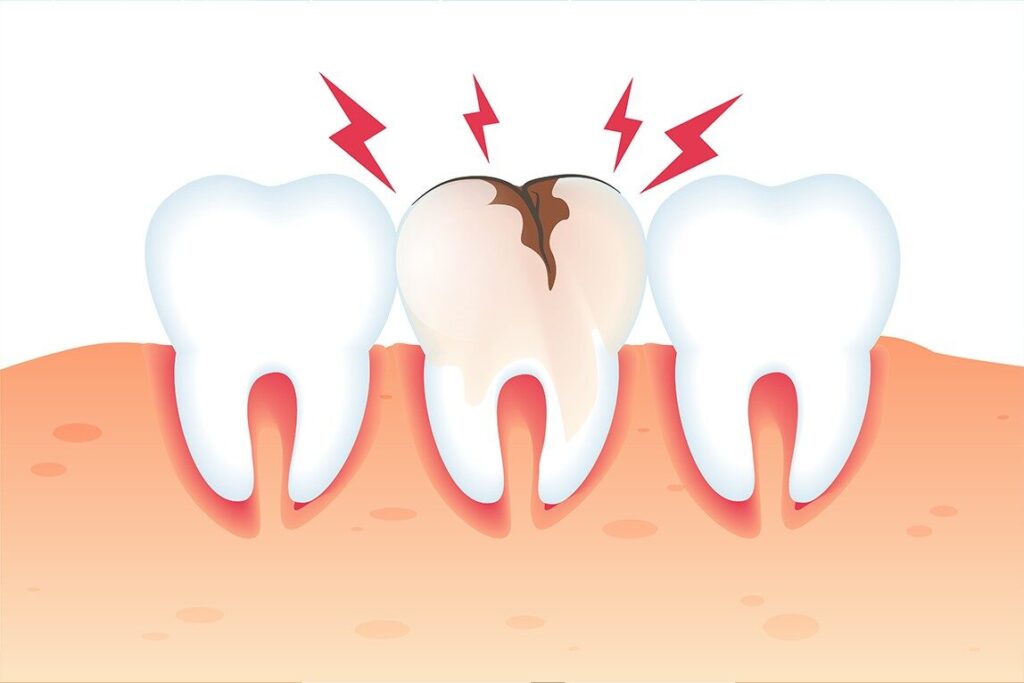 Dental Care Mistakes You Didn’t Know You Were Making 2 A close up illustration of tooth enamel being gradually worn away showing the the effects of over brushing