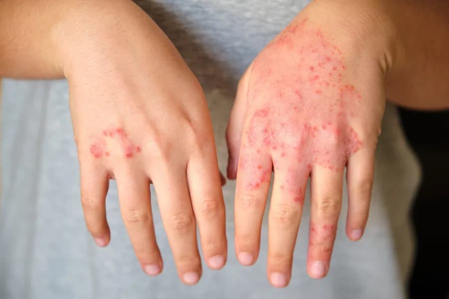 Yoga for Skin Allergies