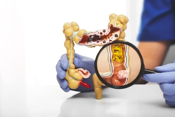 Yoga for Fissure