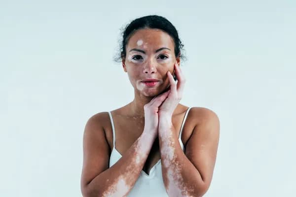 Yoga for Vitiligo