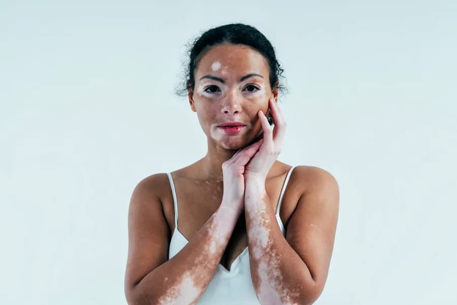 Yoga for Vitiligo