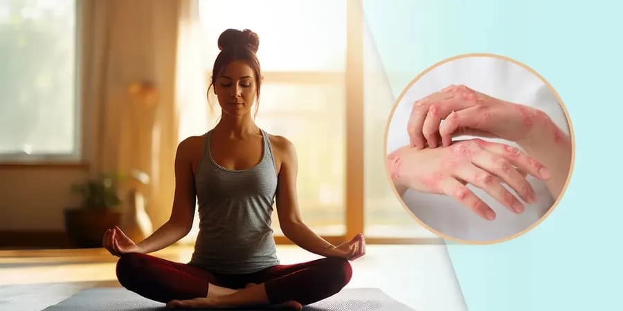 Yoga for Psoriasis: Reduce Stress, Support Skin Health and Build Lasting Resilience